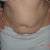 2days before surgery, leaning forward