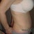 2wks post op morning side view