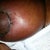 This is my left breast inflamed and red without the tape. VERY itchy and burning slightly