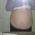 front view pre surgery