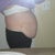 side view pre surgery