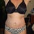 2 MONTHS 1 DAY POST OP