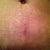 4 week vertical old belly button scar--barely noticeable
