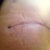 4 week side incision view