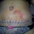 6 Days post op. Plasters came off today.