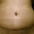 Day 10 PO. Today's belly button shot. Swelling more on my left than right and bb still has some crustiness left to clear up.