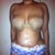 10 days post op- a lot of swelling