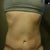 3 Weeks PO.  Swelling continues to go down :)