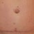 After my 2nd TT.  Longer scar, but pretty straight, thanks Doc :).  And healing is gowing great...I cant say enough about a product called SCARAWAY, you can find easily on Amazon.com.  I have been using ScarAway for 11 weeks, 24 & 7...they suggest 12 weeks but I will try probably double that.  Also this picture was taken April 15, 2012...4 months after my surgery.  Now I think thats a pretty good 4 month scar :)!