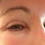 Picture of swollen eye 9 days post op