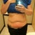 After my first procedure on my lower abdomen. I also had my upper abdomen done.
