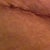 this is the side that was quite puffy. It is by far the uglier looking part of my scar. this is my right hip