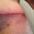 Left hip, see how nice and flat the scar is