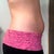 Day after procedure, pretty swollen.