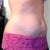 Day after procedure, pretty swollen.