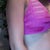 4days after BA bikini top side view