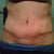 2 weeks post op