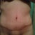 1 month post op