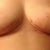 The swelling and bruising in my right breast (left in pic) is obvious here. Also the infected site is really red on my incision under the breast (right in the pic). It is looking much better though!