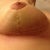 Right breast. Swollen and bruised, yet the healing looks amazing!!!