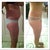 the one on the left is 2 days before the surgery, the one on he right is 3 months post op.. this is my right side