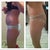 left, 2 days before surgery, right is 3 months post op, this is my left side