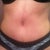 5 weeks post op