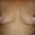 2 days post op