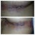 Day 2 Post Op  - some bruising but stitches looks good/clean