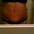 3 weeks post of, lots of swelling above incision line.