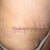 side view of scar revision
