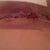 3 days Post-op