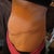 2012 - Thick & ugly scar as well as dog ear lump - before scar revision & 11 & 1/2 months post tt