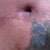 13 week's P/O as you can see the open wound is much smaller