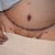 ONE WEEK POST OP..