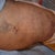 ONE WEEK LIPO AREA