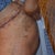 THIGH LIPO AND THE STITCH