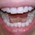 Day 1 - a little crowding in my bottom teeth