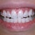 Day 1 - little gap btwn my 2 front teeth. 5 buttons total