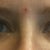 Eyelids before surgery 09/2011