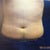 Nearly flat! 9 Days Post Op! Still swelling so it'll be flatter!