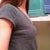 02-05-12.  Before surgery