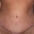 7 weeks after tummy tuck surgery