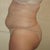 5 Weeks Post (side)