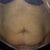 Torn the muscle by a fist and a half from 2 pregnancy with polyhydromnios  4 pregnancy all up