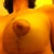 11 Days Post Op Left