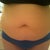 3 1/2 weeks pre-op
