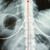 The black circles are air pockets in my body, not the implants. Or so the Chiropractor says.... =) 
The right side of the xray is my right side. Imagine my back is facing you.
The red arrow is just looking at the alignment of my spine- so disregard that.
My bigger implant is on the right (which is my right side) and smaller one on left (left side)