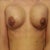 Day 6 post op....they look FUNNY :(