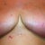 6 weeks post op